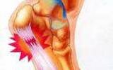 Plantar Fasciitis / Heel Pain, The Chiropractic Approach 